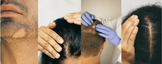 Alopecia Areata